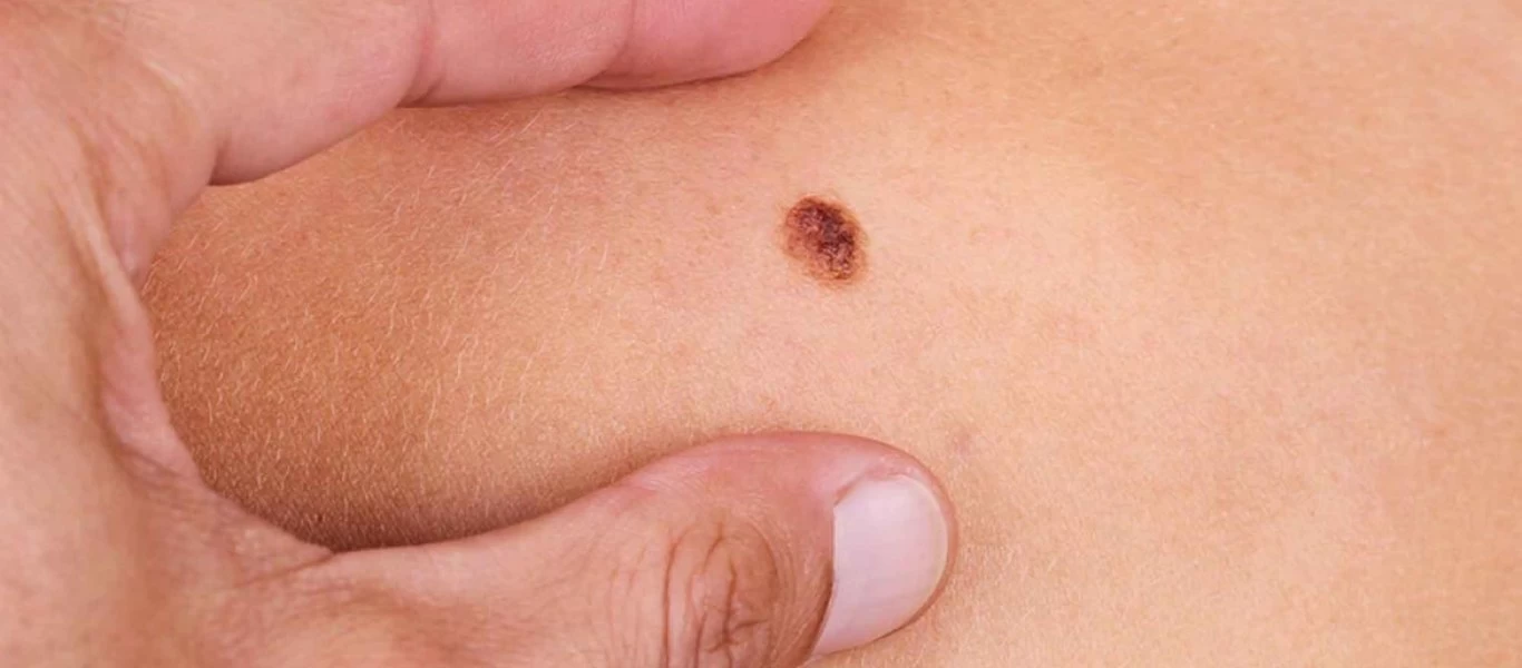 Μελάνωμα: Δείτε πότε μια ελιά στο δέρμα θα πρέπει να σας ανησυχήσει - Τα 5 σημάδια